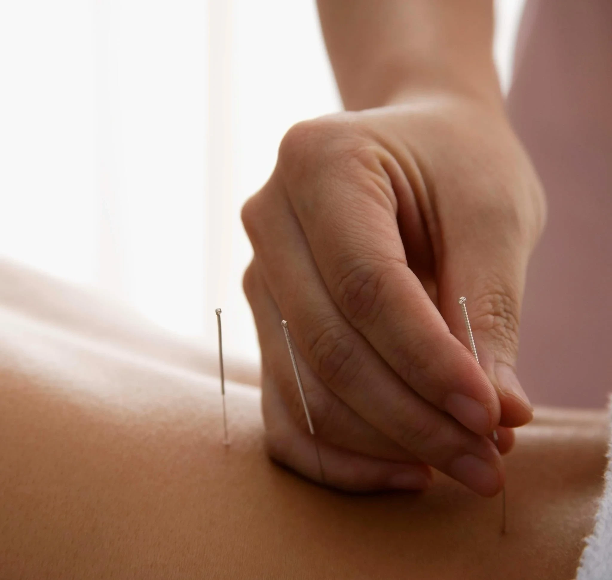 Acupuncture treatment for pain relief at At Ease Physio in South Surrey